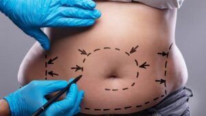 Good-Liposuction-Candidate