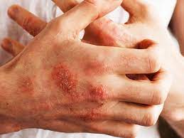 Infection