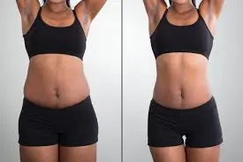 Types of Non-Surgical Fat Reduction Techniques