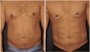 What is Liposuction?